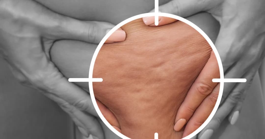 Czy mężczyźni mają cellulit? Przyczyny, różnice i sposoby na redukcję